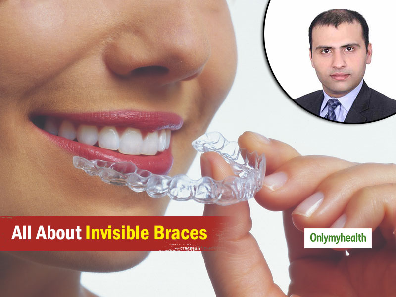 No Wires And No Pain, Dr Gupta Says To Opt For Invisible Braces Over The Conventional Ones